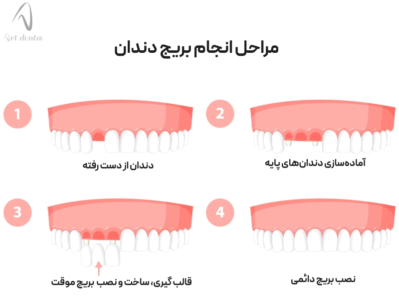 نحوه انجام بریج دندان 