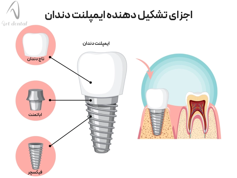 قطعات ایمپلنت