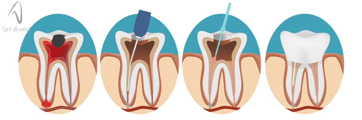 مراحل عصب کشی دندان