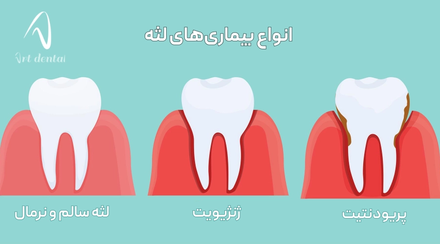 انواع بیماری‌های لثه