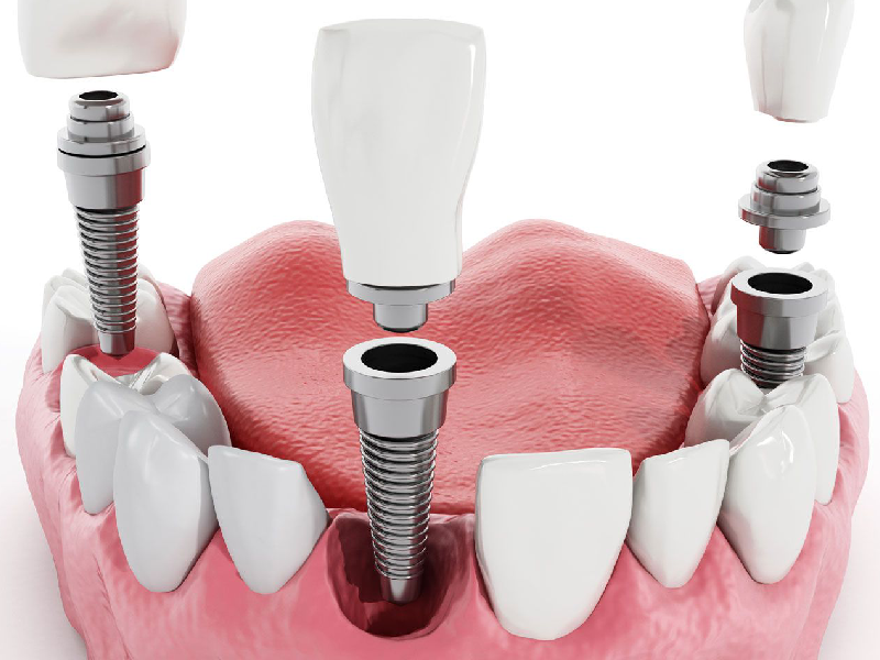 مزایای کاشت ایمپلنت دندان