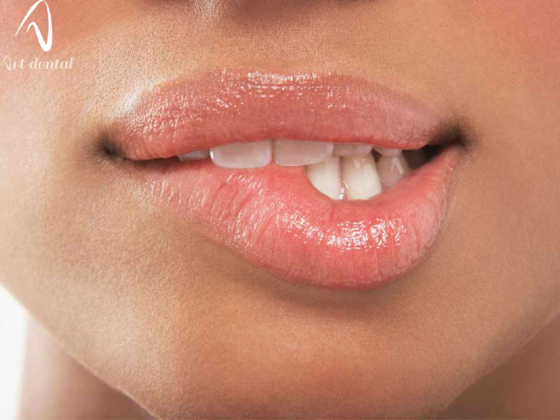 آفت دهان چیست؟