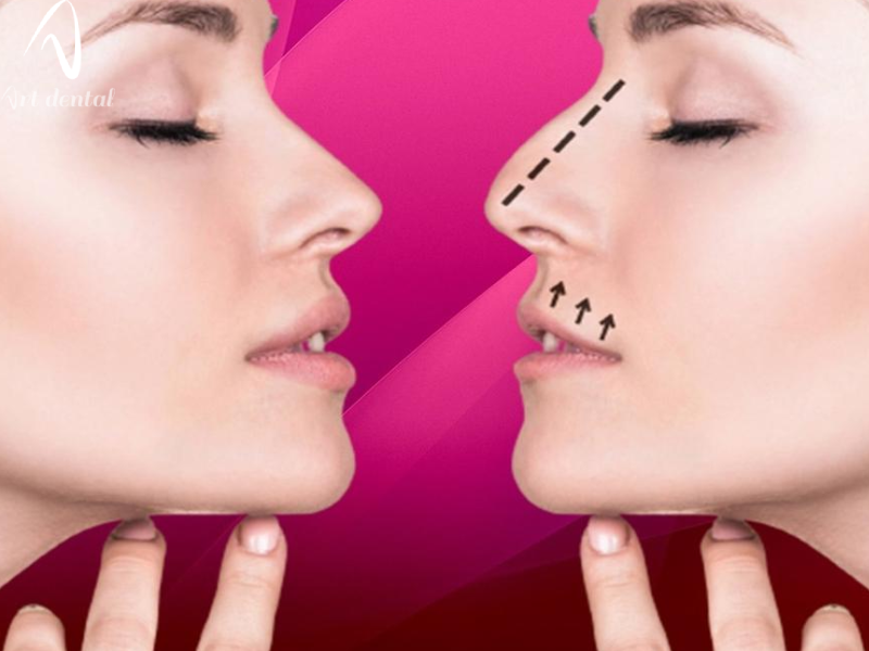 آیا ارتودنسی باعث بزرگ شدن بینی می شود؟