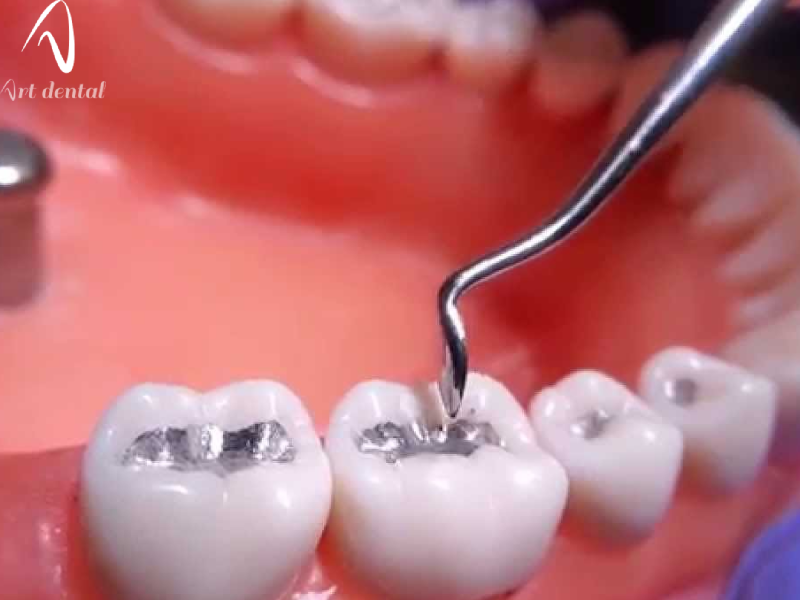 آمالگام چیست؟