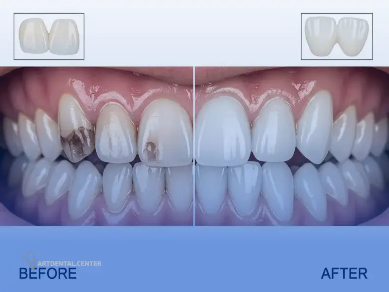 تفاوت در هدف و نتیجه بلیچینگ و لمینت چیست؟