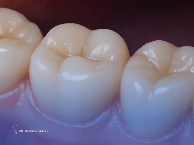 علائم پوسیدگی ثانویه چیست؟