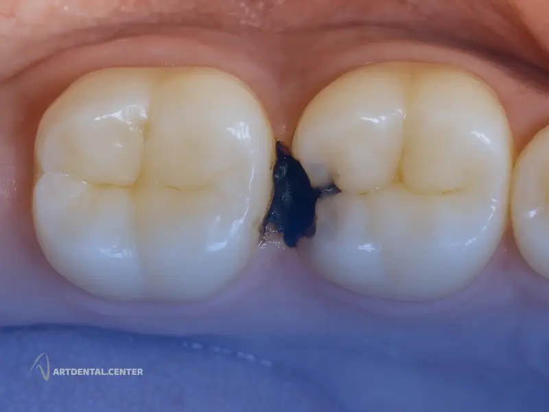 پوسیدگی بین دندانی چگونه تشخیص داده میشود؟