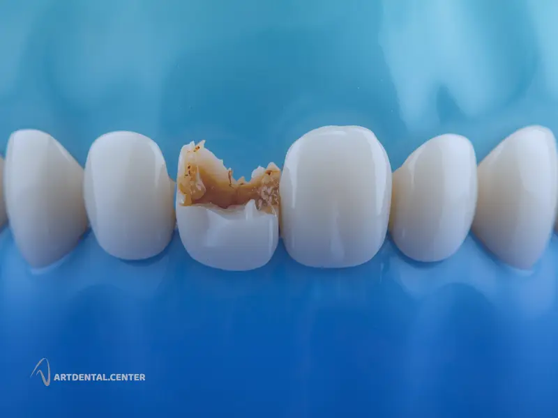 ۶. ایمپلنت در صورت شکستگی شدید