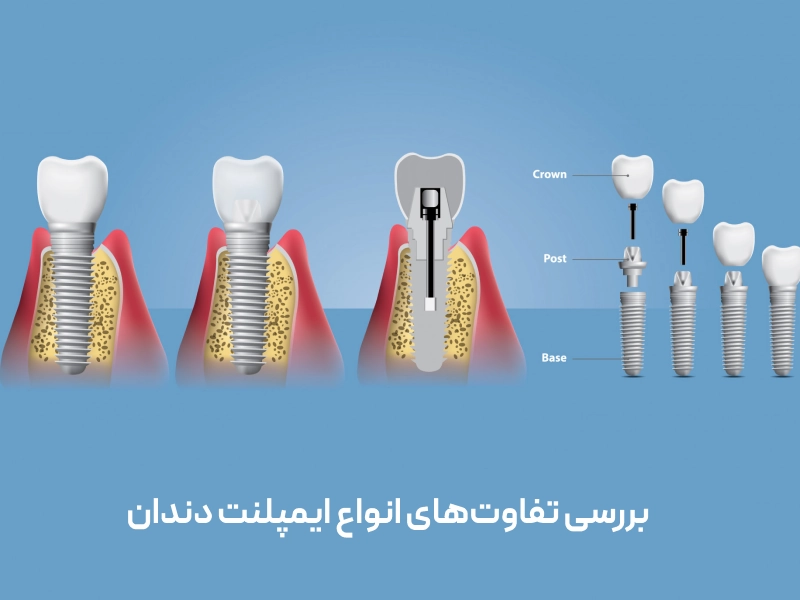 مقایسه و بررسی تفاوت‌های انواع ایمپلنت