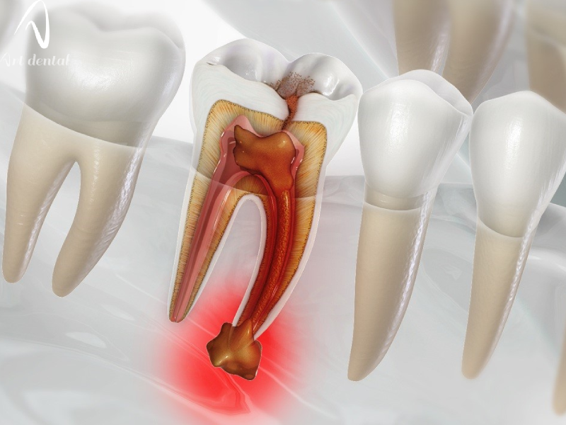 عفونت ریشه دندان