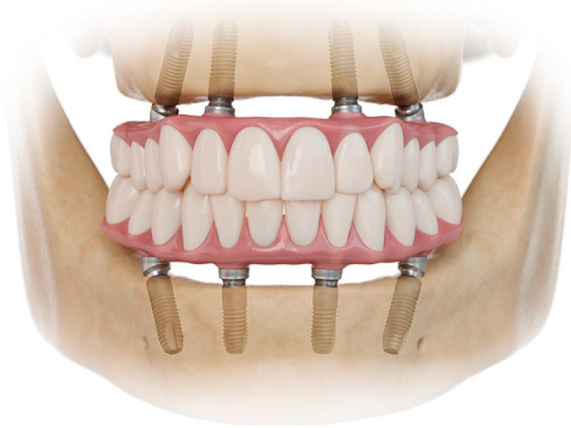 ایمپلنت کامل دندان چیست؟