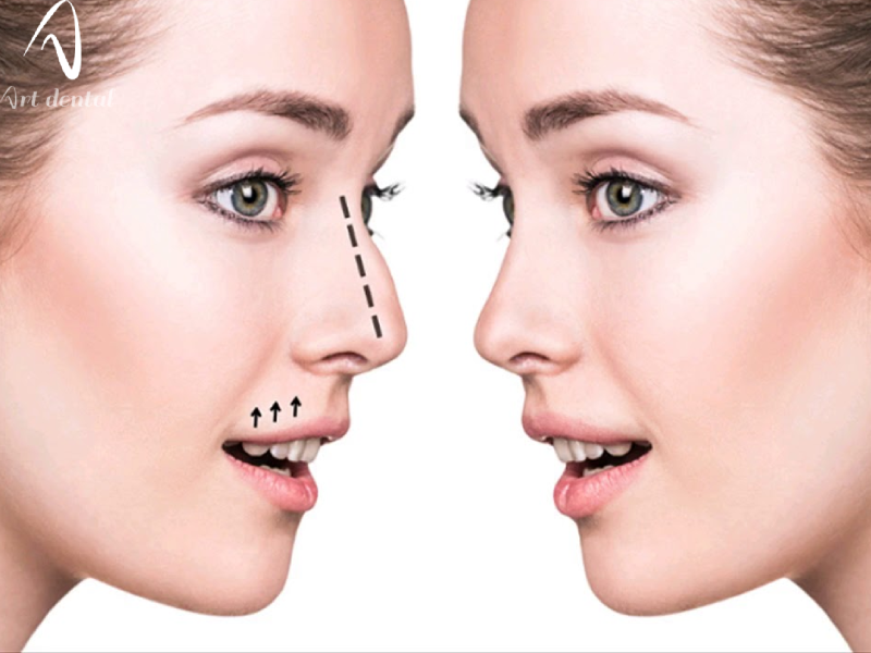 ارتودنسی و جراحی بینی