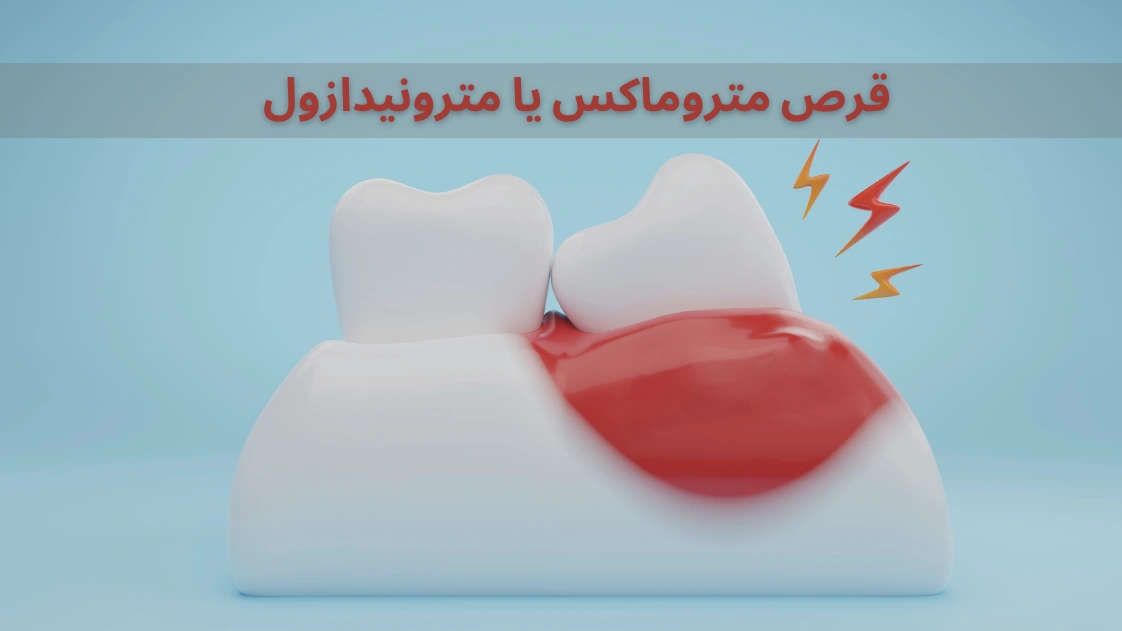 قرص متروماکس برای عفونت دندان و رفع بوی بد دهان