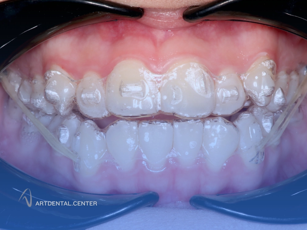 مقایسه ارتودنسی ثابت و متحرک