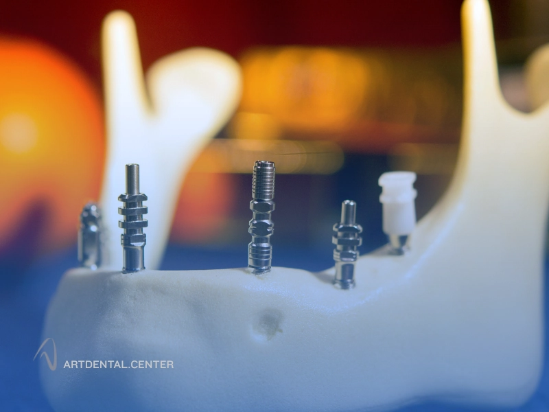 پیوند استخوان کف لگن برای فک