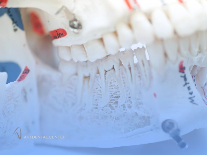 مراحل پیوند استخوان فک