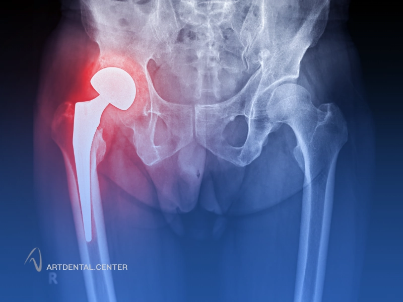 پیوند استخوان کف لگن برای فک چیست؟