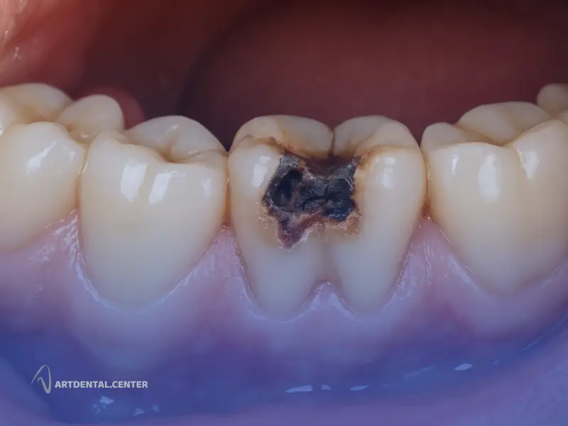 پوسیدگی ثانویه_ چرا دندانی که ترمیم شده دوباره خراب می_شود؟