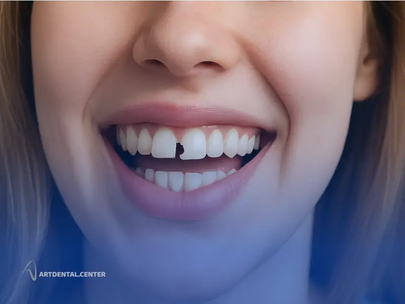 دندان لب_پر شده؛ بهترین روش_های ترمیم از کامپوزیت تا لمینت